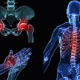 Osteoporosis, quiebra huesos, economía y calidad de vida